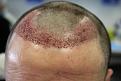 Click image for larger version

Name:	hair transplant 1 day post.jpg
Views:	1674
Size:	85.8 KB
ID:	474832