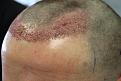 Click image for larger version

Name:	hair transplant 1 day post 1.jpg
Views:	1372
Size:	89.5 KB
ID:	474833