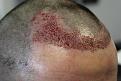 Click image for larger version

Name:	hair transplant 1 day post 2.jpg
Views:	1870
Size:	88.1 KB
ID:	474834