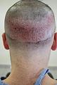 Click image for larger version

Name:	hair transplant 1 day post 3.jpg
Views:	1352
Size:	94.1 KB
ID:	474835