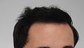 Click image for larger version

Name:	hair transplant 7 mos post 3.jpg
Views:	898
Size:	83.1 KB
ID:	474838