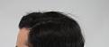 Click image for larger version

Name:	hair transplant 7 mos post 6.jpg
Views:	743
Size:	82.6 KB
ID:	474839