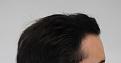 Click image for larger version

Name:	hair transplant 7 mos post 7.jpg
Views:	725
Size:	82.7 KB
ID:	474841