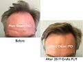 Click image for larger version

Name:	Hair Transplant Slides copy.001.jpg
Views:	345
Size:	13.6 KB
ID:	474854