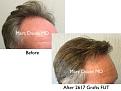 Click image for larger version

Name:	Hair Transplant Slides copy.005.jpg
Views:	336
Size:	14.5 KB
ID:	474855