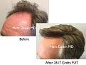 Click image for larger version

Name:	Hair Transplant Slides copy.004.jpg
Views:	337
Size:	15.2 KB
ID:	474856