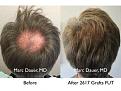 Click image for larger version

Name:	Hair Transplant Slides copy.002.jpg
Views:	371
Size:	19.8 KB
ID:	474858