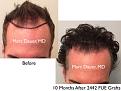 Click image for larger version

Name:	Hair Transplant Slides copy3.001.jpg
Views:	358
Size:	15.5 KB
ID:	474973