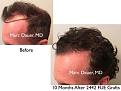 Click image for larger version

Name:	Hair Transplant Slides copy3.002.jpg
Views:	346
Size:	14.8 KB
ID:	474974