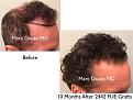 Click image for larger version

Name:	Hair Transplant Slides copy3.003.jpg
Views:	338
Size:	14.9 KB
ID:	474975