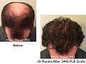 Click image for larger version

Name:	Hair Transplant Slides copy3.004.jpg
Views:	366
Size:	15.9 KB
ID:	474976