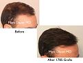 Click image for larger version

Name:	Hair Transplant Slides copy5.003.jpg
Views:	300
Size:	11.4 KB
ID:	475098