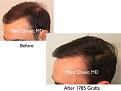 Click image for larger version

Name:	Hair Transplant Slides copy5.002.jpg
Views:	218
Size:	12.0 KB
ID:	475099
