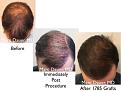 Click image for larger version

Name:	Hair Transplant Slides copy5.004.jpg
Views:	239
Size:	15.2 KB
ID:	475100