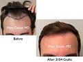 Click image for larger version

Name:	Hair Transplant Slides copy6.001.jpg
Views:	381
Size:	12.8 KB
ID:	475136