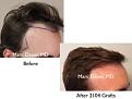 Click image for larger version

Name:	Hair Transplant Slides copy6.003.jpg
Views:	343
Size:	12.6 KB
ID:	475138