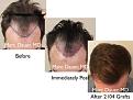 Click image for larger version

Name:	Hair Transplant Slides copy6.004.jpg
Views:	374
Size:	14.8 KB
ID:	475139
