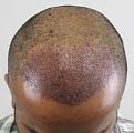 Click image for larger version

Name:	1 day post-op.jpg
Views:	473
Size:	51.0 KB
ID:	475167