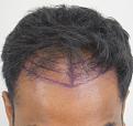 Click image for larger version

Name:	pre-op (1).JPG
Views:	476
Size:	96.0 KB
ID:	475173