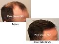 Click image for larger version

Name:	Hair Transplant Slides copy9.003.jpg
Views:	423
Size:	12.2 KB
ID:	475209