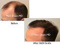 Click image for larger version

Name:	Hair Transplant Slides copy9.002.jpg
Views:	282
Size:	11.9 KB
ID:	475210