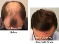 Click image for larger version

Name:	Hair Transplant Slides copy9.004.jpg
Views:	313
Size:	14.9 KB
ID:	475211