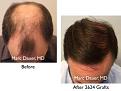 Click image for larger version

Name:	Hair Transplant Slides copy9.004.jpg
Views:	437
Size:	14.9 KB
ID:	475211