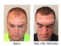 Click image for larger version

Name:	Hair Transplant Slides copy12.001.jpg
Views:	342
Size:	14.2 KB
ID:	475334
