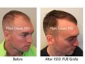 Click image for larger version

Name:	Hair Transplant Slides copy12.003.jpg
Views:	321
Size:	14.4 KB
ID:	475336
