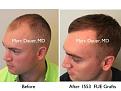 Click image for larger version

Name:	Hair Transplant Slides copy12.004.jpg
Views:	259
Size:	14.6 KB
ID:	475337