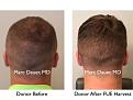 Click image for larger version

Name:	Hair Transplant Slides copy12.005.jpg
Views:	330
Size:	14.8 KB
ID:	475338