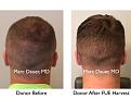 Click image for larger version

Name:	Hair Transplant Slides copy12.005.jpg
Views:	257
Size:	14.8 KB
ID:	475338