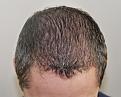 Click image for larger version

Name:	bh 18 month post chin down.jpg
Views:	559
Size:	92.0 KB
ID:	475378