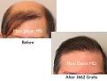 Click image for larger version

Name:	Hair Transplant Slides copy15.006.jpg
Views:	281
Size:	11.8 KB
ID:	475455