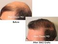 Click image for larger version

Name:	Hair Transplant Slides copy15.007.jpg
Views:	374
Size:	12.8 KB
ID:	475456