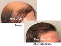 Click image for larger version

Name:	Hair Transplant Slides copy15.008.jpg
Views:	345
Size:	13.4 KB
ID:	475457
