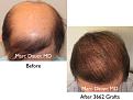 Click image for larger version

Name:	Hair Transplant Slides copy15.009.jpg
Views:	312
Size:	15.0 KB
ID:	475458