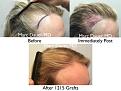 Click image for larger version

Name:	Hair Transplant Slides copy15.004.jpg
Views:	237
Size:	17.1 KB
ID:	475521