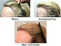 Click image for larger version

Name:	Hair Transplant Slides copy15.005.jpg
Views:	300
Size:	17.0 KB
ID:	475522