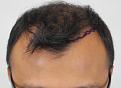 Click image for larger version

Name:	pre-op (1).JPG
Views:	406
Size:	73.0 KB
ID:	475552