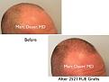 Click image for larger version

Name:	Hair Transplant Slides copy17.003.jpg
Views:	995
Size:	11.4 KB
ID:	475584