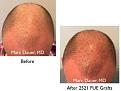 Click image for larger version

Name:	Hair Transplant Slides copy17.004.jpg
Views:	1163
Size:	13.6 KB
ID:	475585