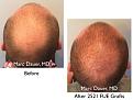 Click image for larger version

Name:	Hair Transplant Slides copy17.005.jpg
Views:	9309
Size:	15.5 KB
ID:	475586