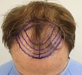 Click image for larger version

Name:	pre-op (3).jpg
Views:	461
Size:	42.8 KB
ID:	475597