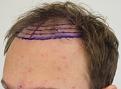 Click image for larger version

Name:	pre-op (4).JPG
Views:	440
Size:	80.1 KB
ID:	475598