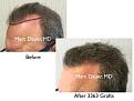 Click image for larger version

Name:	Hair Transplant Slides copy21.002.jpg
Views:	415
Size:	14.0 KB
ID:	475665