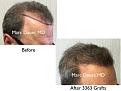 Click image for larger version

Name:	Hair Transplant Slides copy21.003.jpg
Views:	311
Size:	13.7 KB
ID:	475666