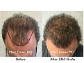 Click image for larger version

Name:	Hair Transplant Slides copy21.004.jpg
Views:	422
Size:	18.1 KB
ID:	475667