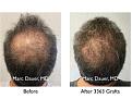 Click image for larger version

Name:	Hair Transplant Slides copy21.005.jpg
Views:	332
Size:	17.9 KB
ID:	475668