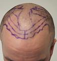 Click image for larger version

Name:	pre-op (6).JPG
Views:	390
Size:	74.6 KB
ID:	475677